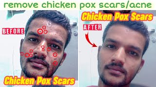 Chickenpox  Symptoms  Causes In Hindi  चिकनपाॅक्स छोटी माताchicken pox [upl. by Llenol]