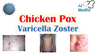 Chicken Pox in hindi Chicken pox Symptoms  DrKSChougule [upl. by Notlem9]