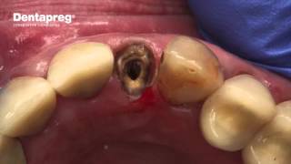 Emergency Repair of Loose Crown [upl. by Haskins]