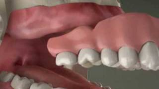 Dental Implants  Implant Overdenture in Denville NJ [upl. by Drews]