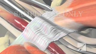 Cubital Tunnel Syndrome  Ulnar Nerve Transposition [upl. by Ahsinhoj]