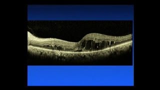 How do eye injections intravitreal injections work [upl. by Eatnoj]