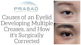 Probable Cause of Multiple Folds on the Upper Eyelid and How to Correct it Surgically [upl. by Nnyltiak120]