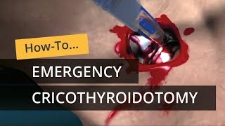 Emergency Cricothyroidotomy using CricKey [upl. by Atilek870]