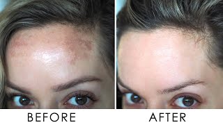 How I Got Rid Of Pigmentation  Melasma  Shonagh Scott [upl. by Eberle891]