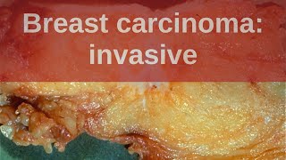 Invasive Breast Cancer We Teach You The Essentials [upl. by Pat353]