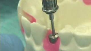 Placing Implant Abutments [upl. by Pacien]