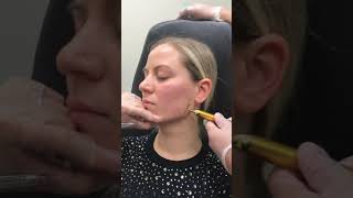 Jawline Filler Injection Technique by Dr Tina Ho [upl. by Anelak130]