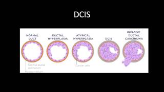 Breast Cancer Review Series DCIS and IDC [upl. by Aniryt]