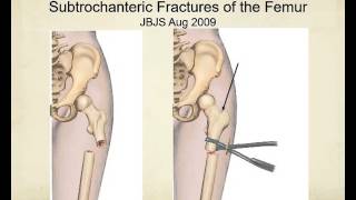 Proximal femur fractures how to identify and avoid malreduction malrotation [upl. by Neelat]