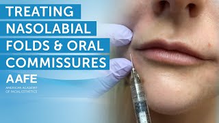 Using Dermal Fillers to Fill and Smooth Smile Lines  AAFE [upl. by Peria705]