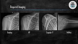 Proximal Humerus Fracture [upl. by Salli]