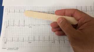 pericarditis on EKG [upl. by Ruiz]