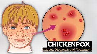 Chickenpox Causes Signs and Symptoms Diagnosis and Treatment [upl. by Enyledam389]