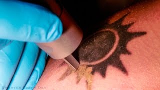 How Laser Tattoo Removal Works  Smarter Every Day 123 [upl. by Niltak]