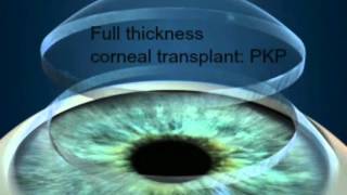 DMEK surgery sutureless corneal transplant [upl. by Prentice]