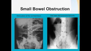 Small bowel obstruction [upl. by Iad478]