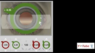 Retinoscopy Basics  Dr Zain Khatib [upl. by Layne237]