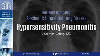 Hypersensitivity Pneumonitis [upl. by Notyal]