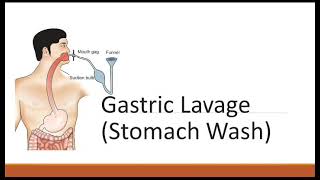 Gastric Lavage Stomach Wash [upl. by Ecart]