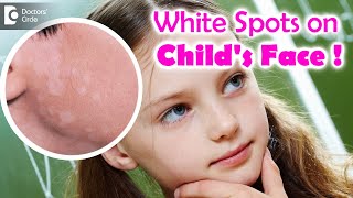 5 Things to know if your child is suffering from Pityriasis Alba  Dr Divya SharmaDoctors Circle [upl. by Olaf]