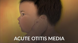 Acute Otitis Media by A Ruan J Cheng  OPENPediatrics [upl. by Enilesoj]