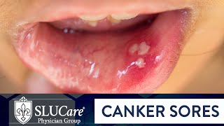 Determining Causes amp Treatment for Canker Sores  SLUCare Otolaryngology [upl. by Asalocin]