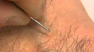 How to remove an ingrown hair [upl. by Brenda]