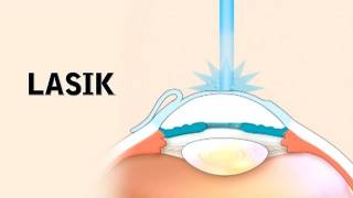 LASIK Surgery and its Risks [upl. by Lissie788]