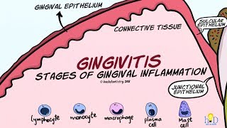 Gingivitis Stages of Gingival Inflammation [upl. by Leahplar]