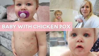 Chicken Pox Treatment Symptoms Diagnosis Management Infectious Medicine Lecture USMLENCLEX [upl. by Aissatsana]