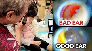 EAR INFECTION vs PERFECT EAR Inside Look  Dr Paul [upl. by Ecnadnak507]