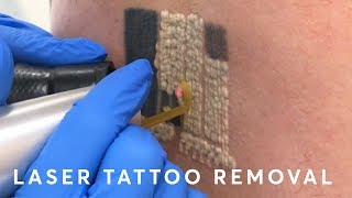 Laser Tattoo Removal PAIN RESULTS amp PROCEDURE [upl. by Dnomaid]