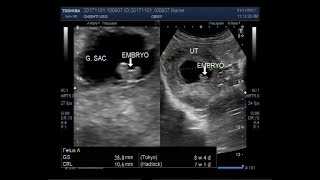 Ultrasound Video showing a case of missed miscarriage of about 7 to 8 weeks [upl. by Colley]