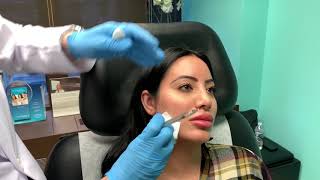 Contouring the Jaw with Facial Fillers [upl. by Myriam]