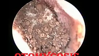 Severe Fungal infection Removal  Otomycosis ear cleaning by OtoEndoscopy [upl. by Helve]