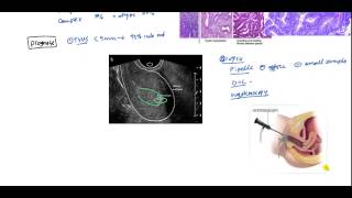 Endometrial Cancer and Hyperplasia for USMLE [upl. by Nylde733]