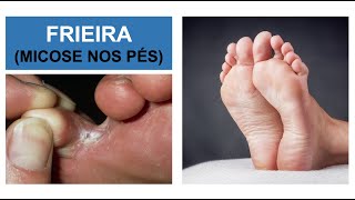 MICOSE NOS PÉS Frieira  Como combater Por Luiz Gameiro dermatologista [upl. by Ennaitsirk449]