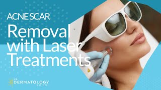 Acne Scar Removal with Laser Treatments [upl. by Amlus]