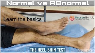 Heel to Shin TEST coordinationtest Normal Abnormal assessment procedure cerebellum neurology [upl. by Dralliw]