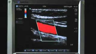 Sonosite MTurbo Product Training Part 2 Screen Layout [upl. by Arihsat]