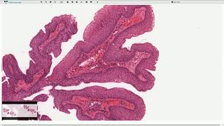 Squamous Papilloma  Larynx  Histopathology [upl. by Ielak]