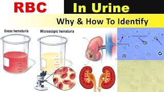 RBC In Urine  Why amp How to Identify [upl. by Tulley]