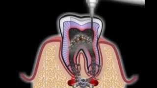 Wurzelbehandlung beim Zahnarzt [upl. by Sindee]