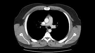 Anatomy of CT scans Thoracic cavity [upl. by Mabelle833]