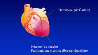 5 à 7 Dépister et prévenir linsuffisance cardiaque [upl. by Asilav]