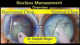 Phaco BasicsNucleus management pearls amp pitfalls  Dr Deepak Megur [upl. by Wright5]