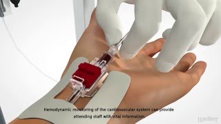 MEDBAR  Arterial Cannula [upl. by Eceinhoj]