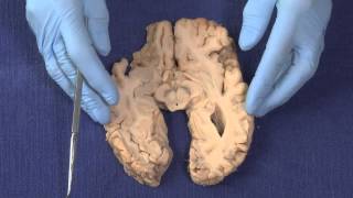 Basal Ganglia Neuroanatomy Video Lab  Brain Dissections [upl. by Joann]