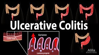 Ulcerative Colitis Pathophysiology Symptoms Risk factors Diagnosis and Treatments Animation [upl. by Lalib114]